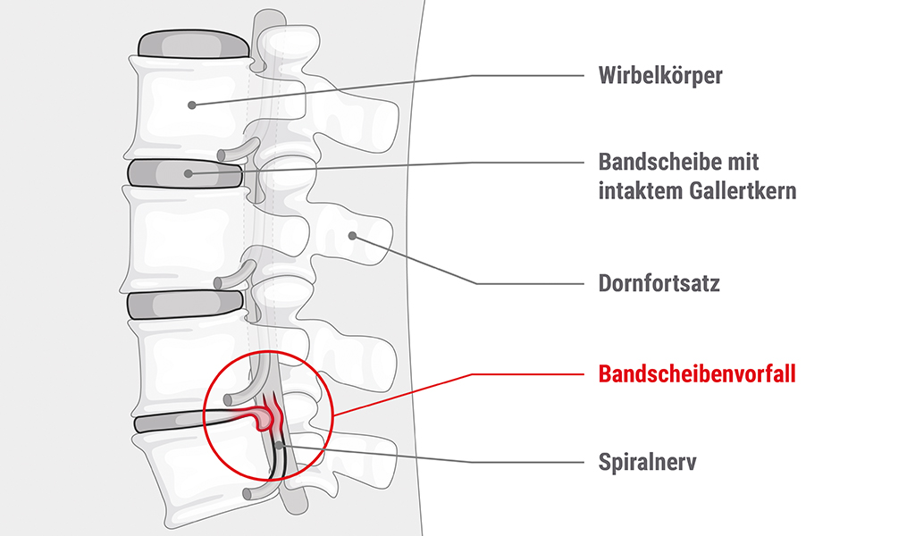 Illustration: Ein Stück einer Wirbelsäule, Beschriftung: Wirbelkörper, Bandscheibe mit intaktem Gallertkern, Dornfortsatz, Bandscheibenvorfall, Spiralnerv