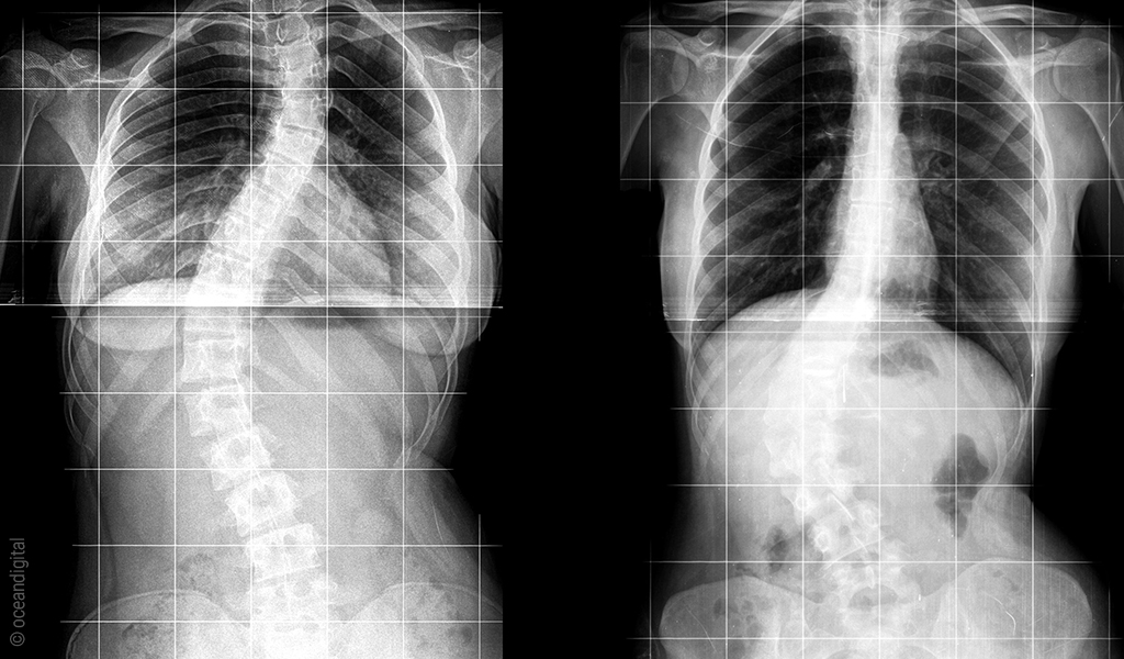 Röntgenbild: Zwei Aufnahmen einer nach links gekrümmten mittig sitzenden (thorakolumbalen) Skoliose.