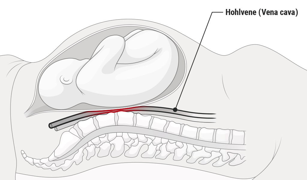 Illustration vom Querschnitt eines schwangeren Körpers in Rückenlage: oben die Gebärmutter mit Baby, unten die Wirbelsäule. Dazwischen eingequetscht und rötlich eingefärbt die Hohlvene (Vena cava).