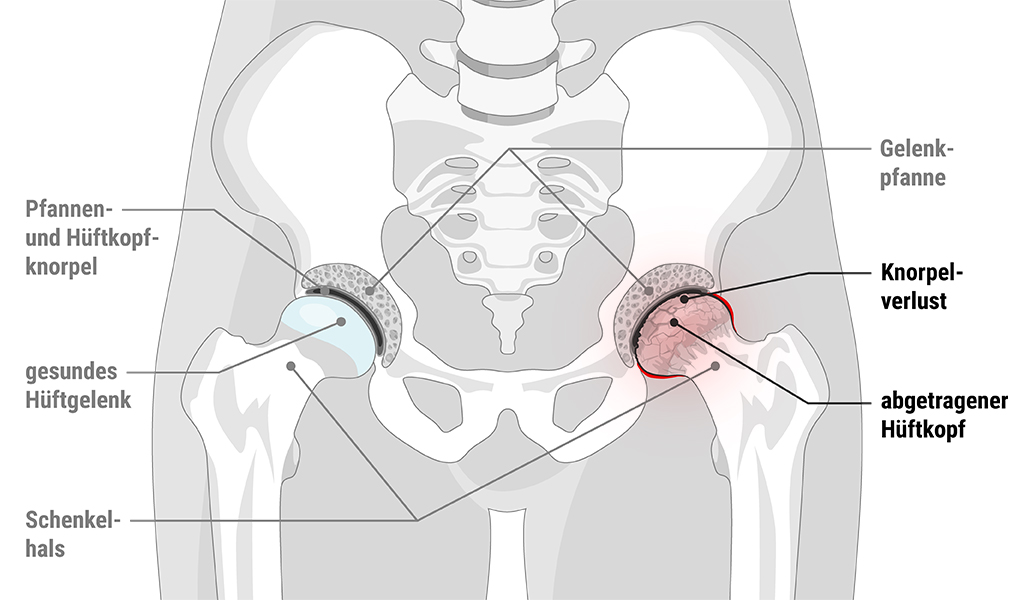 Illustration der Hüftknochen und Gelenke, links ein blau eingefärbter Gelenkkopf mit Text: „gesundes Hüftgelenk”, rechts ein rot eingefärbter Gelenkkopf mit Text „Knorpelverlust” und „abgetragener Hüftkopf”
