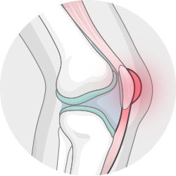 Illustration: Ein Kniegelenk im Querschnitt mit entzündetem Schleimbeutel. 