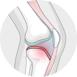 Illustration: Ein Kniegelenk im Querschnitt, bei dem eine Knorpelscheibe verletzt ist. 